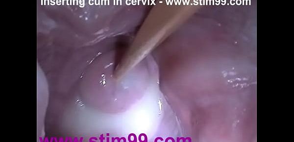 Insertion Semen Cum in Cervix Wide Stretching Pussy Speculum